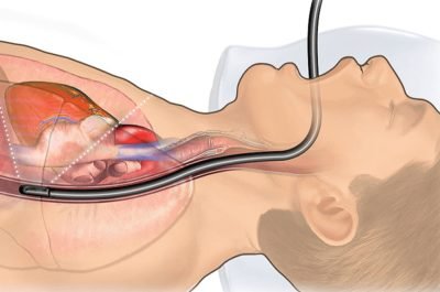 Gastroscopy Gastroscopy