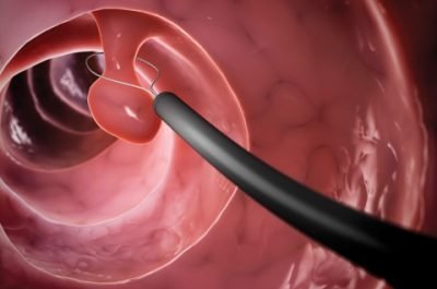 Colonoscopy Colonoscopy