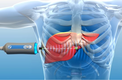Fibroscan Fibroscan